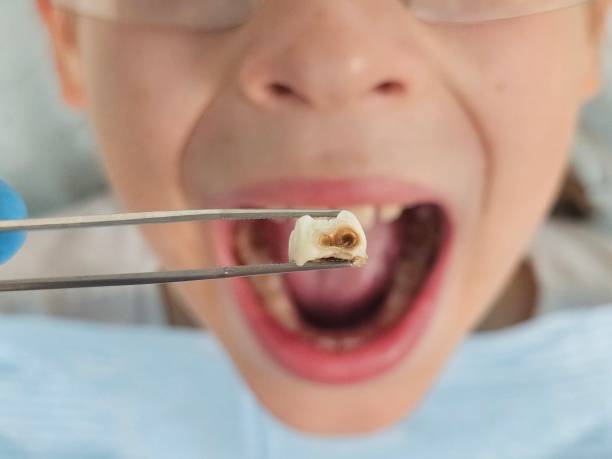 Best Knocked-Out Tooth (Avulsed Tooth) Treatment in Red Cloud, NE